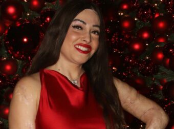 Ιωάννα Παλιοσπύρου: Συγκλονίζει 6 χρόνια μετά την επίθεση με βιτριόλι – «Πίστεψα πως όλα τελείωσαν»