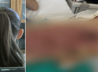Συγκλονίζει η 20χρονη εγκαυματίας στη Θεσσαλονίκη: «Ο γιατρός μου έριξε ένα υγρό και άρχισα να καίγομαι αφόρητα»