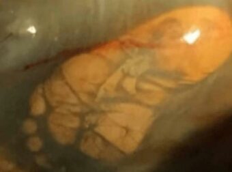 Ήταν 40 εβδομάδων έγκυος, αλλά δεν πήγε ποτέ στον γιατρό για εξετάσεις. Αυτό που έδειξε ο 1ος υπέρηχος, την έκανε να παγώσει